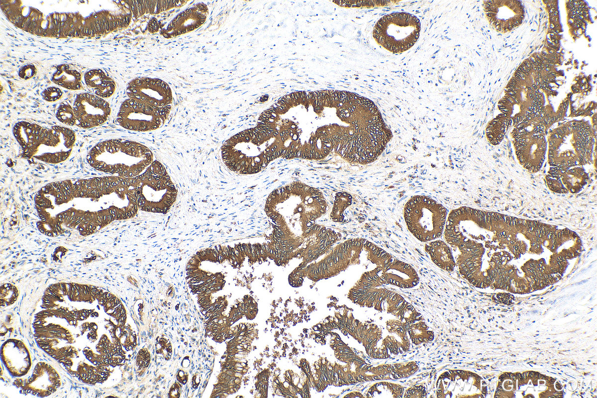 IHC staining of human pancreas cancer using 80593-1-RR