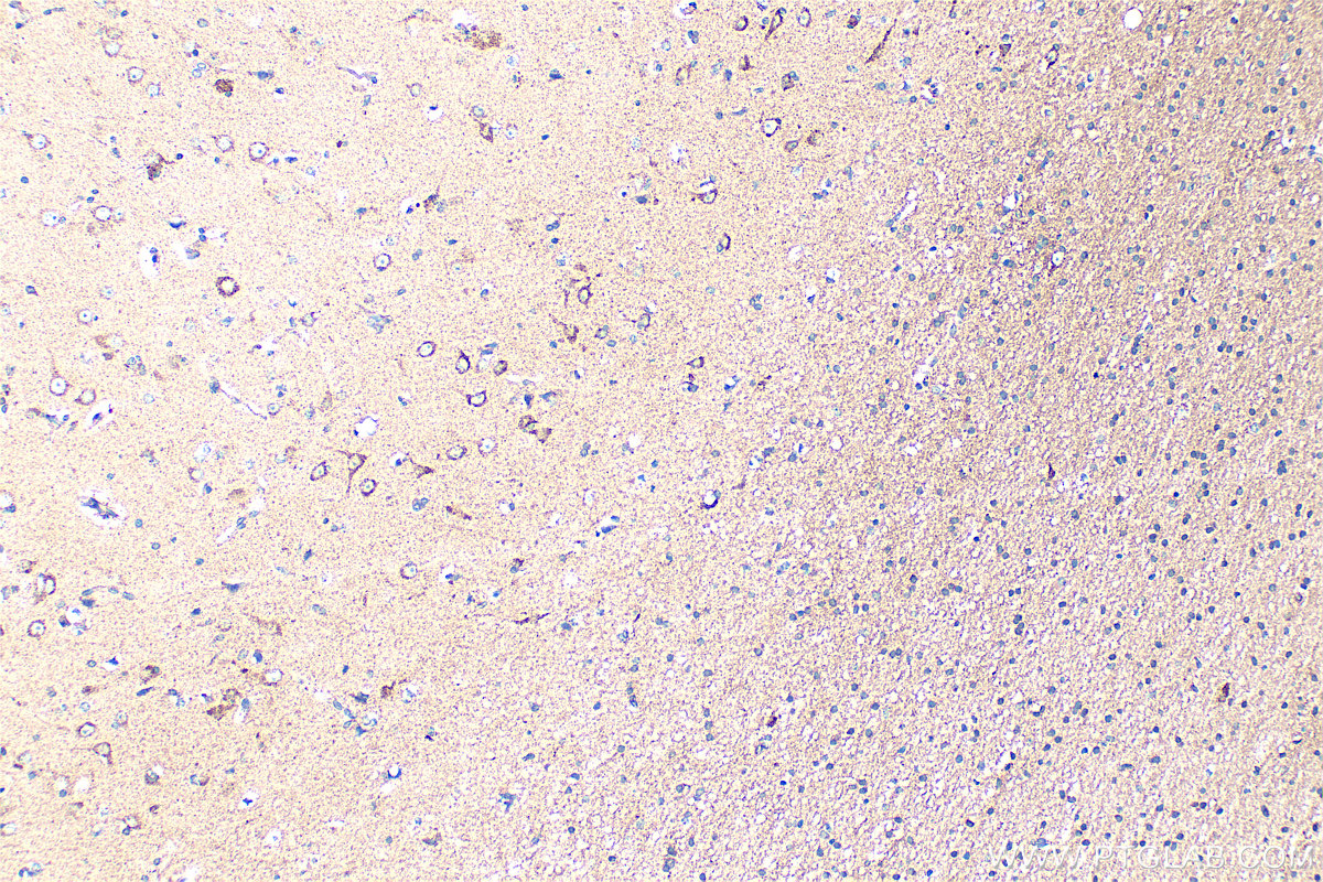 Immunohistochemical analysis of paraffin-embedded human gliomas tissue slide using 20690-1-AP (NRG2 antibody) at dilution of 1:200 (under 10x lens). Heat mediated antigen retrieval with Tris-EDTA buffer (pH 9.0). IHC staining of human gliomas using 20690-1-AP