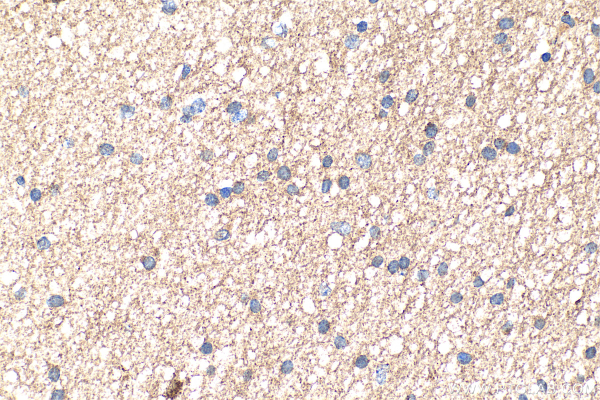 Immunohistochemical analysis of paraffin-embedded human gliomas tissue slide using 20690-1-AP (NRG2 antibody) at dilution of 1:200 (under 40x lens). Heat mediated antigen retrieval with Tris-EDTA buffer (pH 9.0). IHC staining of human gliomas using 20690-1-AP