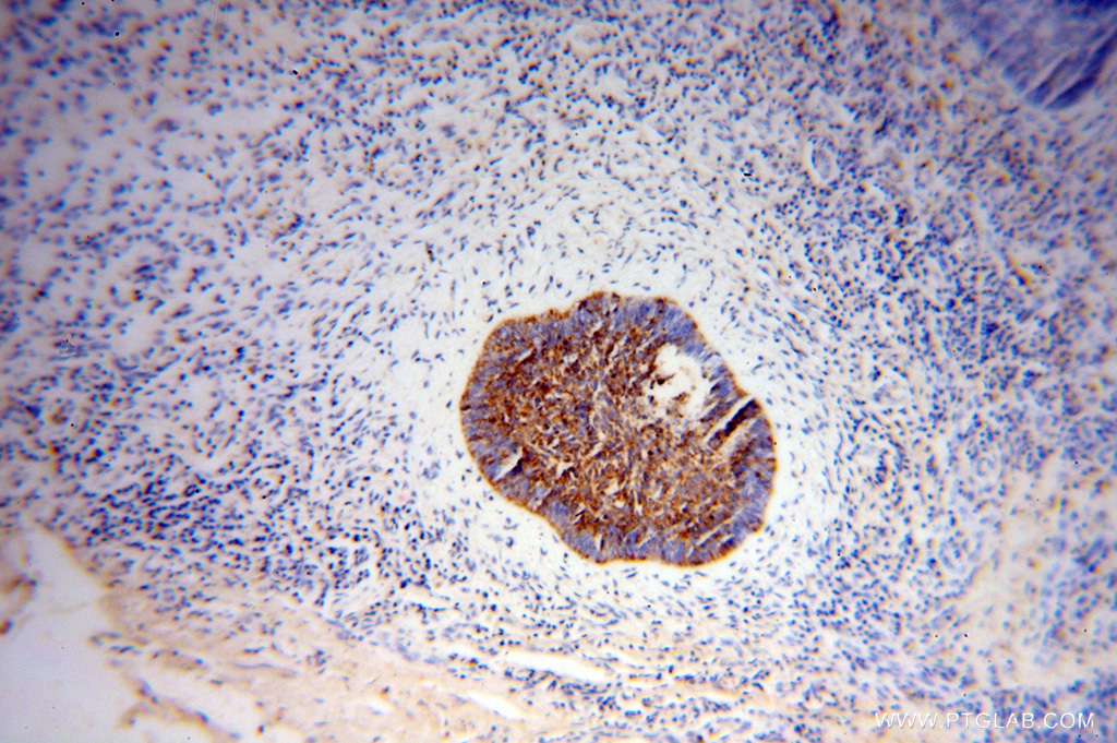 IHC staining of human skin cancer using 15111-1-AP