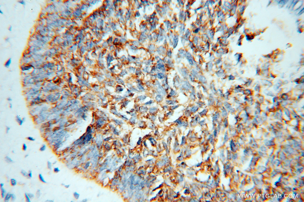 IHC staining of human skin cancer using 15111-1-AP