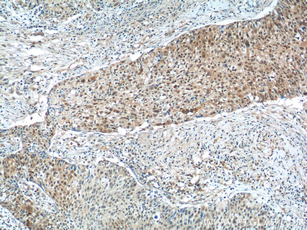 IHC staining of human lung cancer using 15620-1-AP