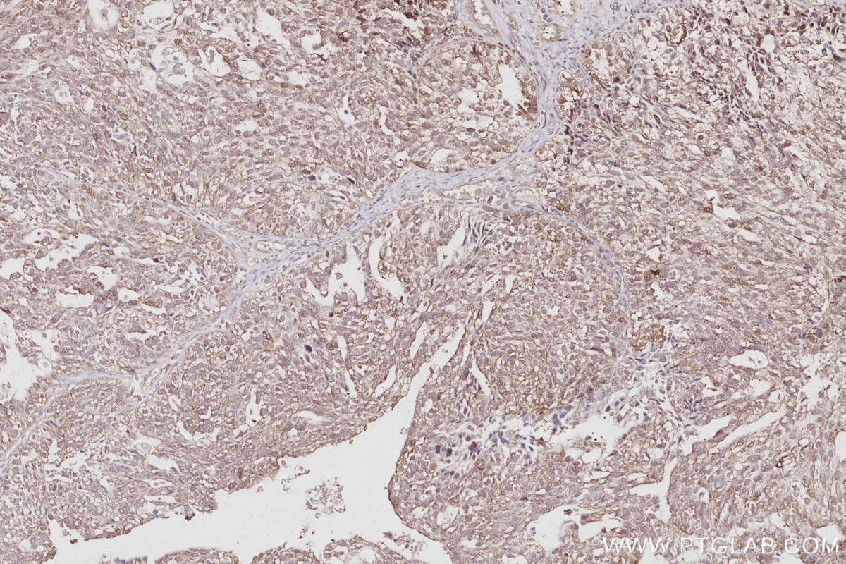 IHC staining of human ovary cancer using 68182-1-Ig IHC staining of human ovary cancer using 68182-1-Ig