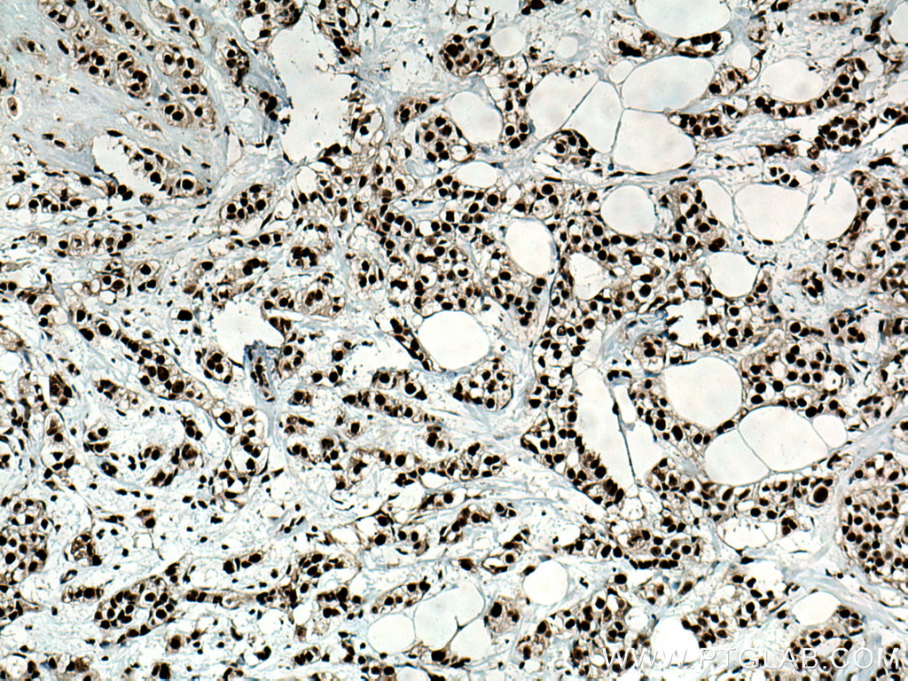 IHC staining of human breast cancer using 20854-1-AP