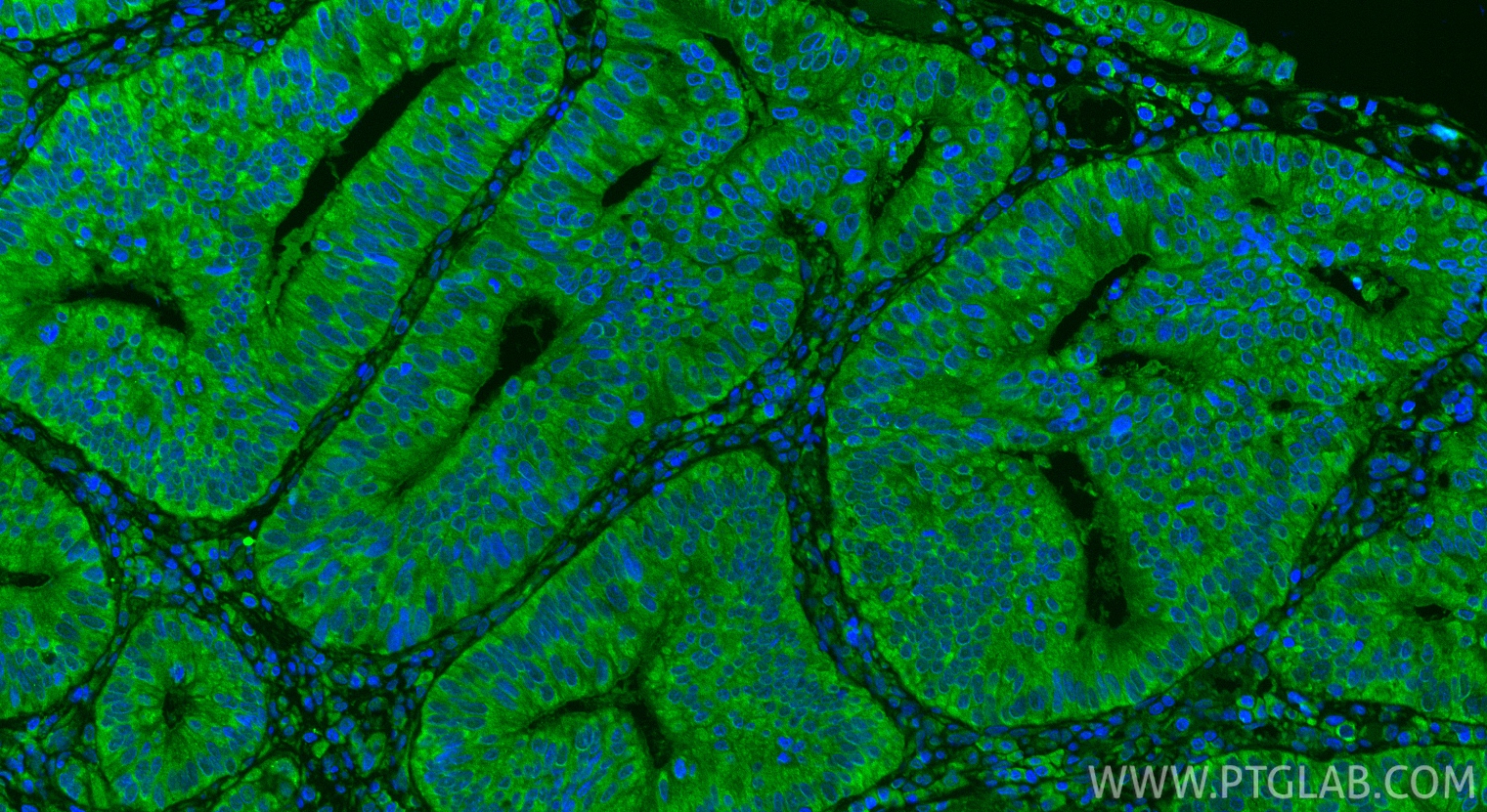 IF Staining of human colon cancer using 17240-1-AP