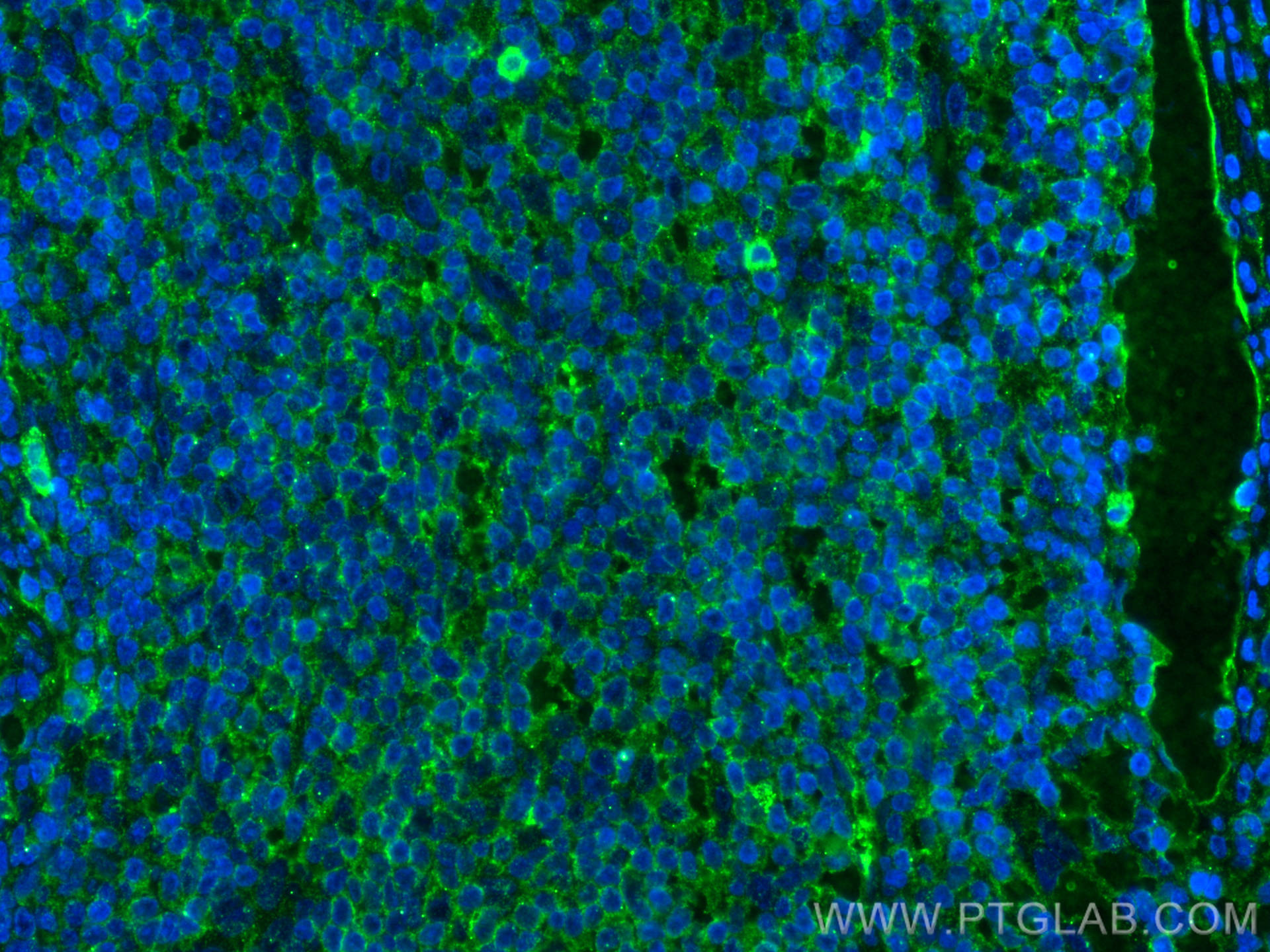IF Staining of human appendicitis using 67789-1-Ig