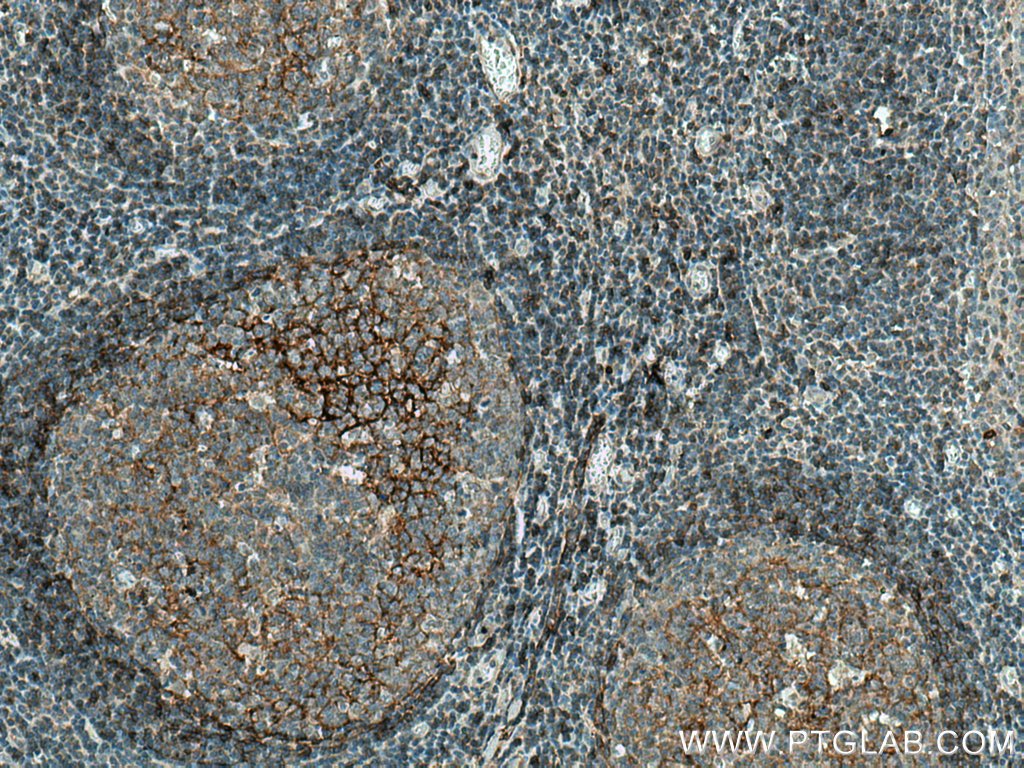 IHC staining of human tonsillitis using 67789-1-Ig