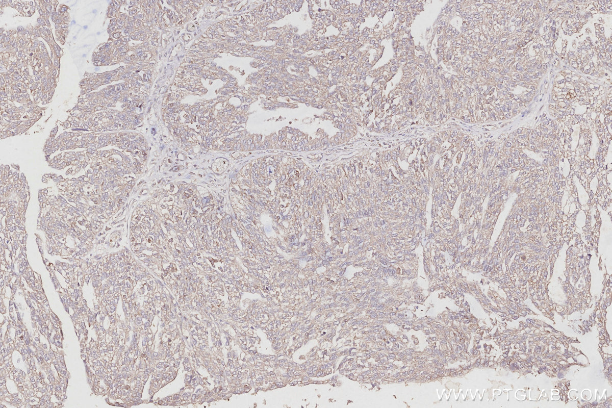 IHC staining of human ovary cancer using 10681-1-AP IHC staining of human ovary cancer using 10681-1-AP