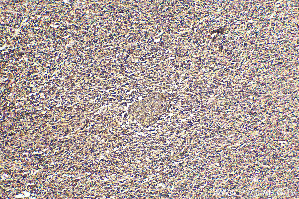 IHC staining of human pancreas cancer using 10681-1-AP (same clone as 10681-1-PBS) IHC staining of human pancreas cancer using 10681-1-AP (same clone as 10681-1-PBS)