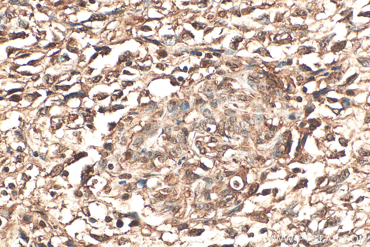 IHC staining of human pancreas cancer using 10681-1-AP (same clone as 10681-1-PBS) IHC staining of human pancreas cancer using 10681-1-AP (same clone as 10681-1-PBS)