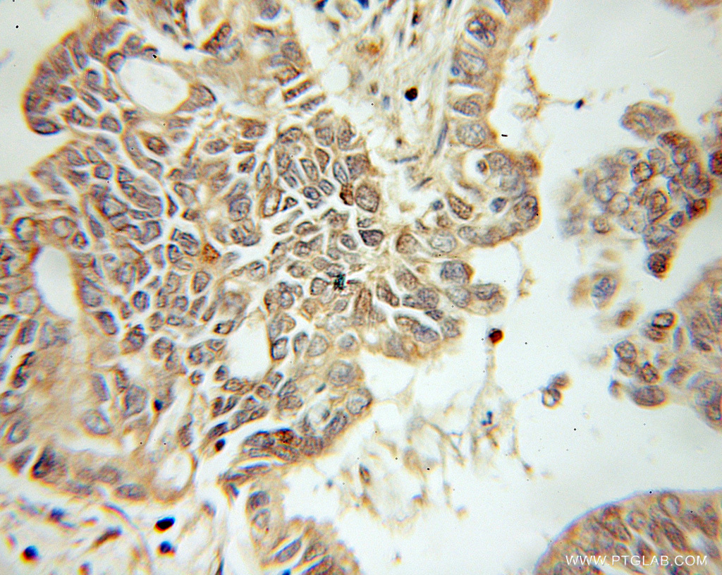 IHC staining of human pancreas cancer using 10681-1-AP