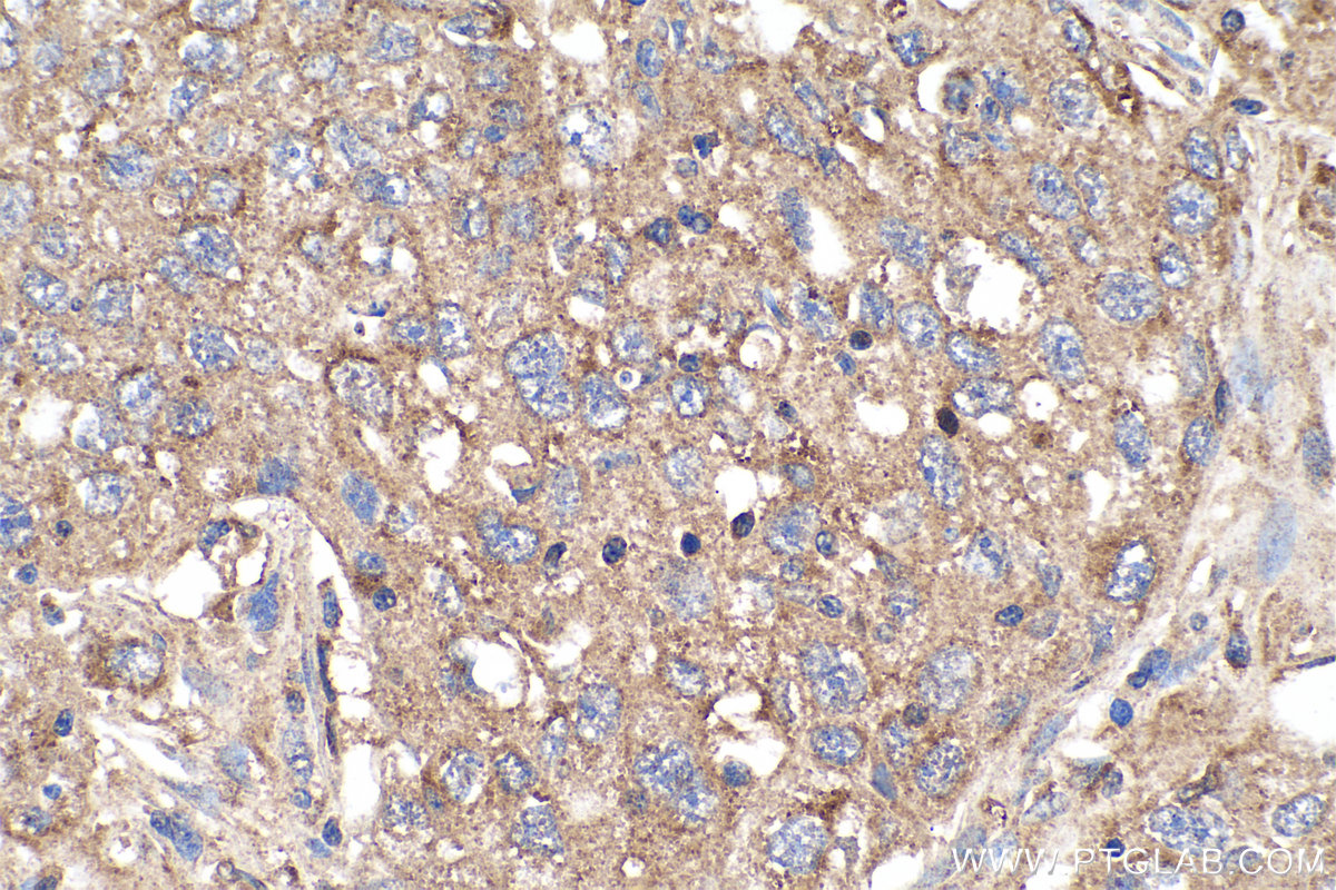 IHC staining of human lung cancer using 16705-1-AP