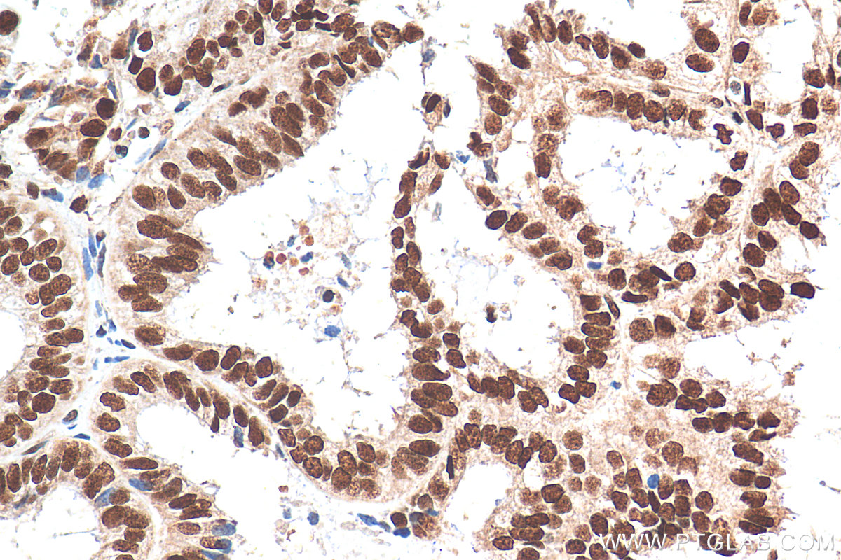 IHC staining of human ovary tumor using 12515-1-AP