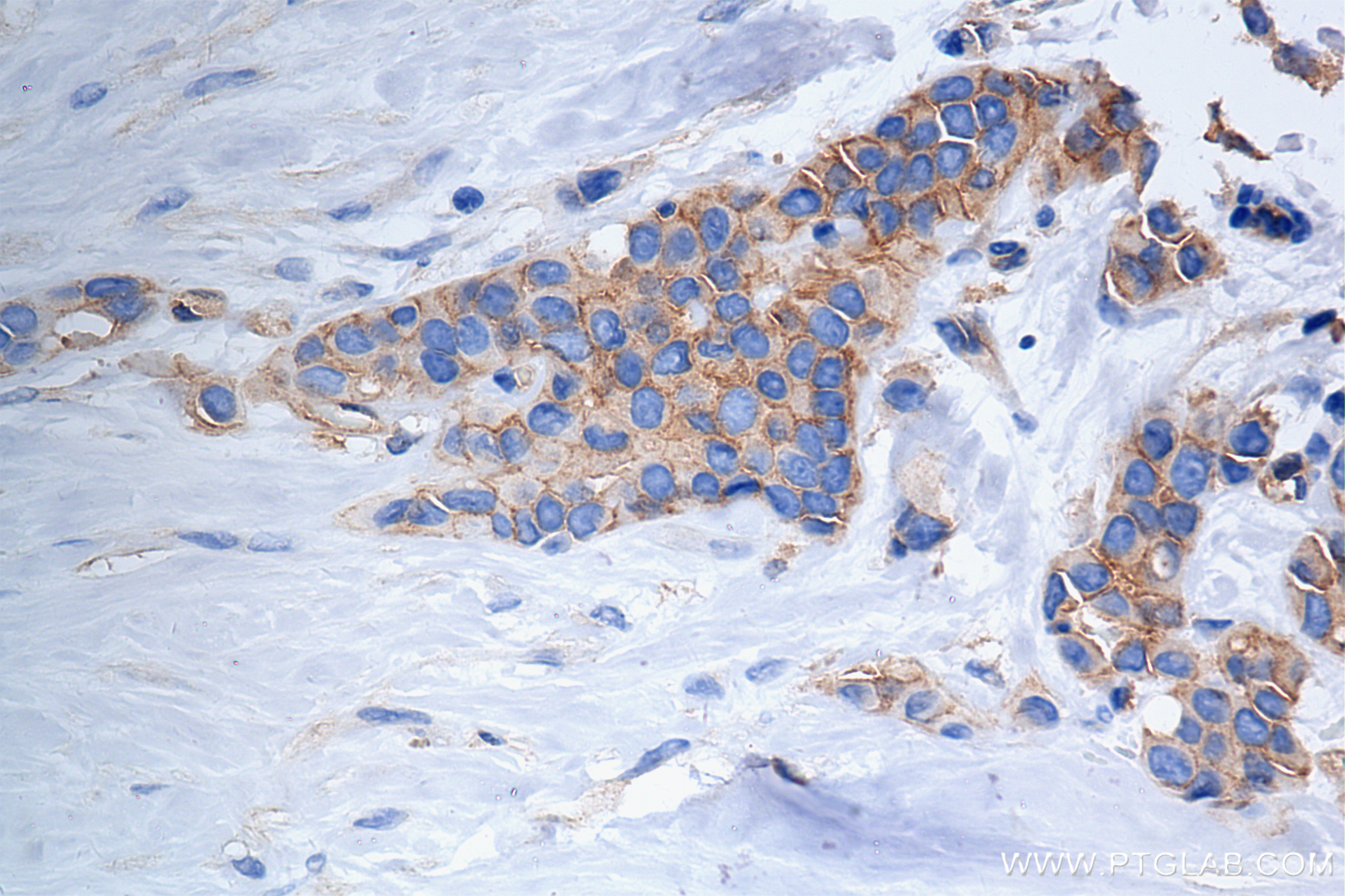 IHC staining of human breast cancer using 85939-4-RR (same clone as 85939-4-PBS)