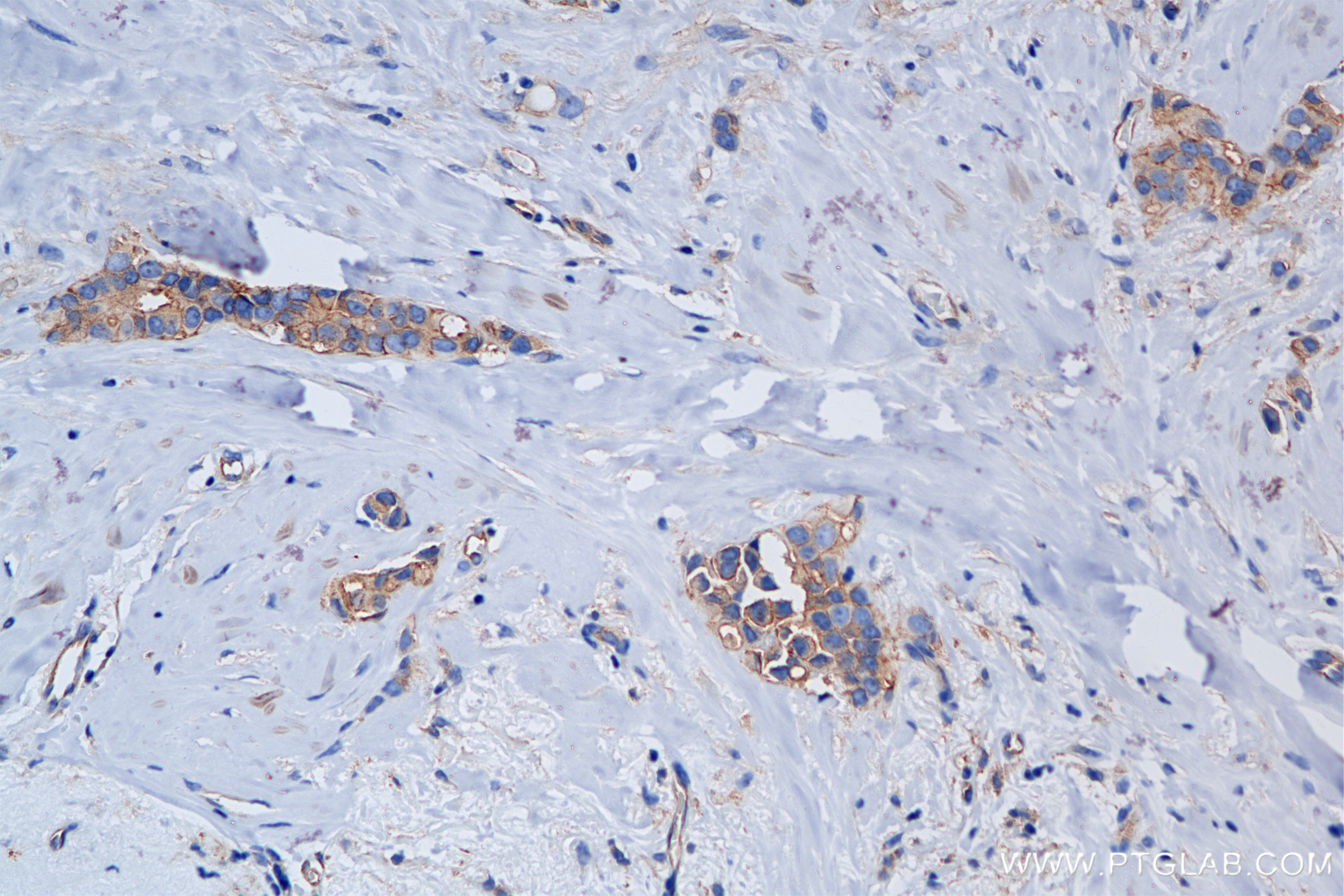 IHC staining of human breast cancer using 85939-4-RR (same clone as 85939-4-PBS)
