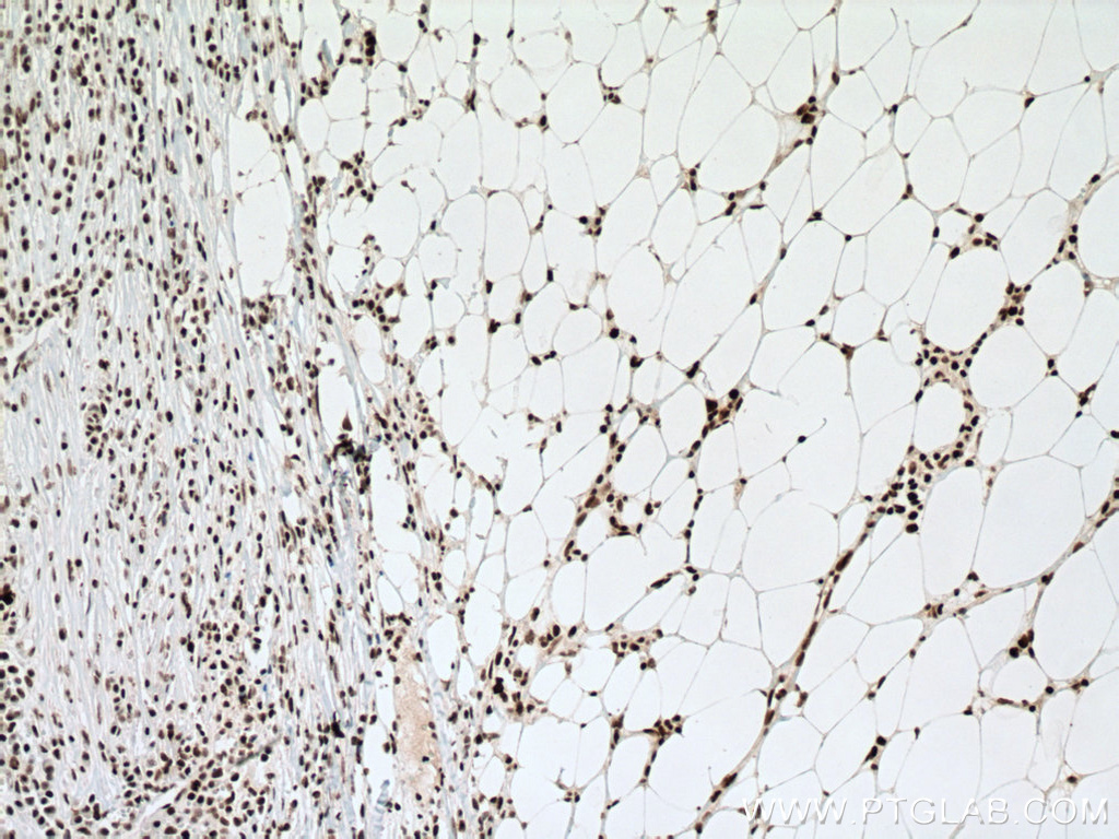 IHC staining of human breast cancer using 20798-1-AP