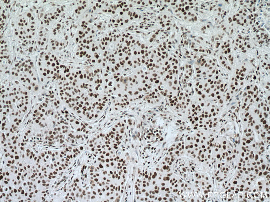 IHC staining of human breast cancer using 20798-1-AP