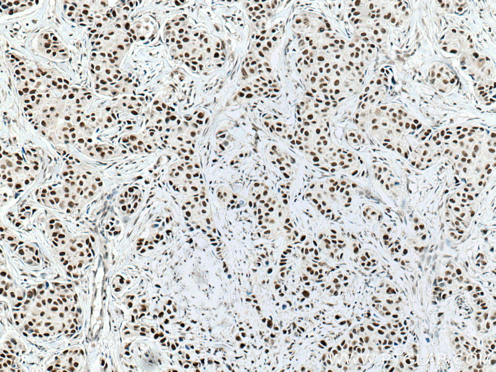 IHC staining of human breast cancer using 67001-1-Ig