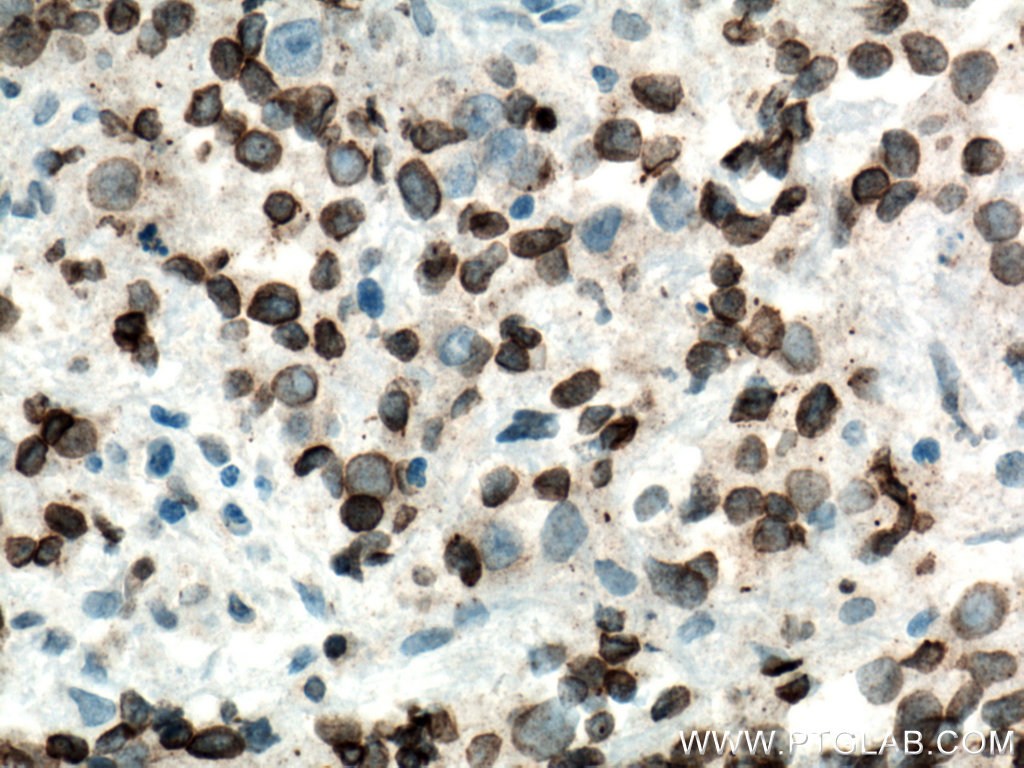 IHC staining of human prostate cancer using 66573-1-Ig