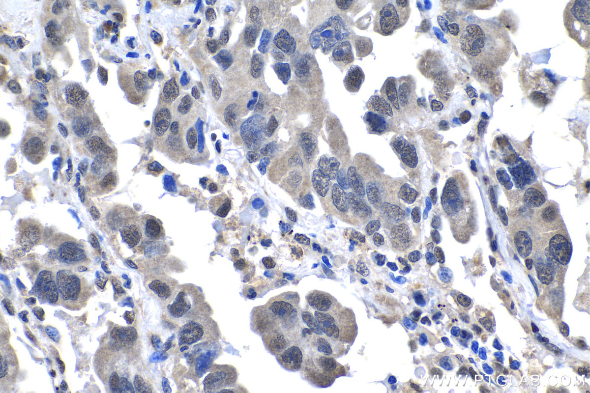 IHC staining of human lung cancer using 25381-1-AP