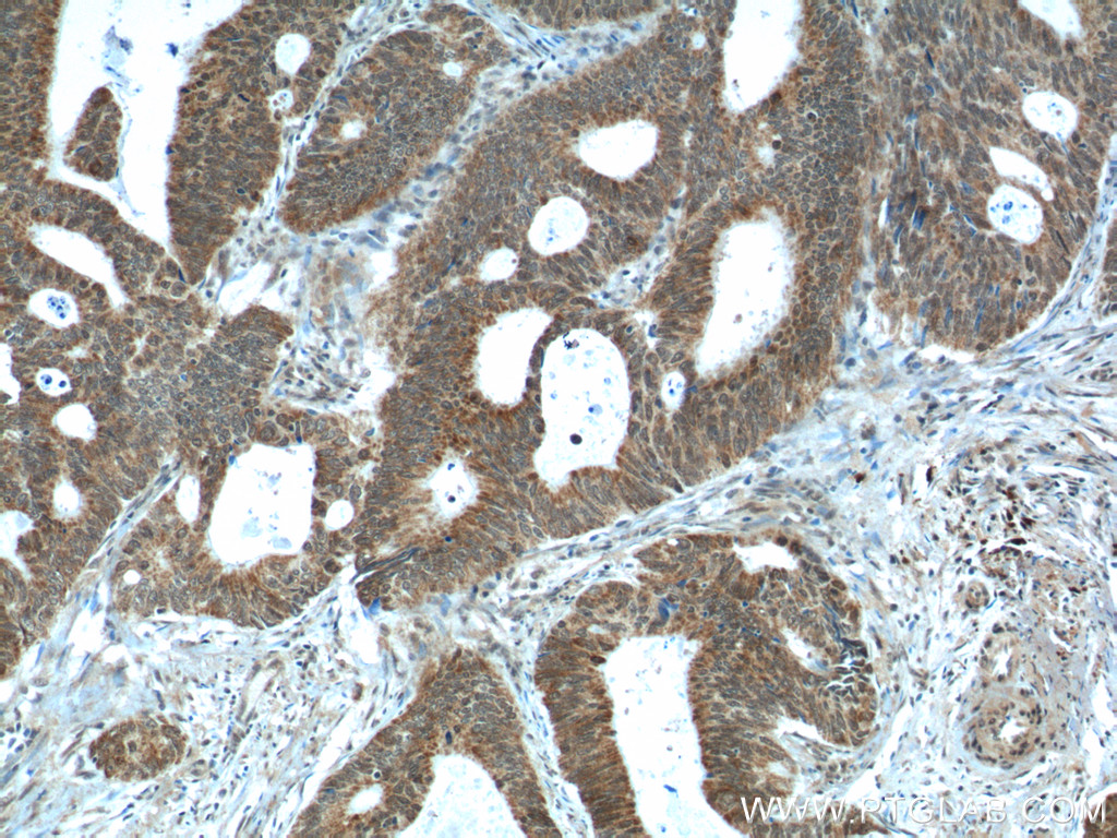 IHC staining of human colon cancer using 15056-1-AP