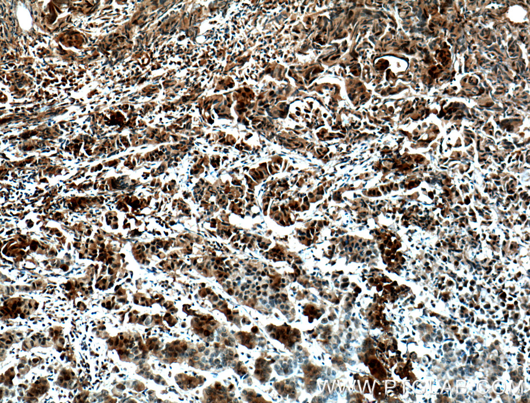 IHC staining of human prostate cancer using 12024-1-AP