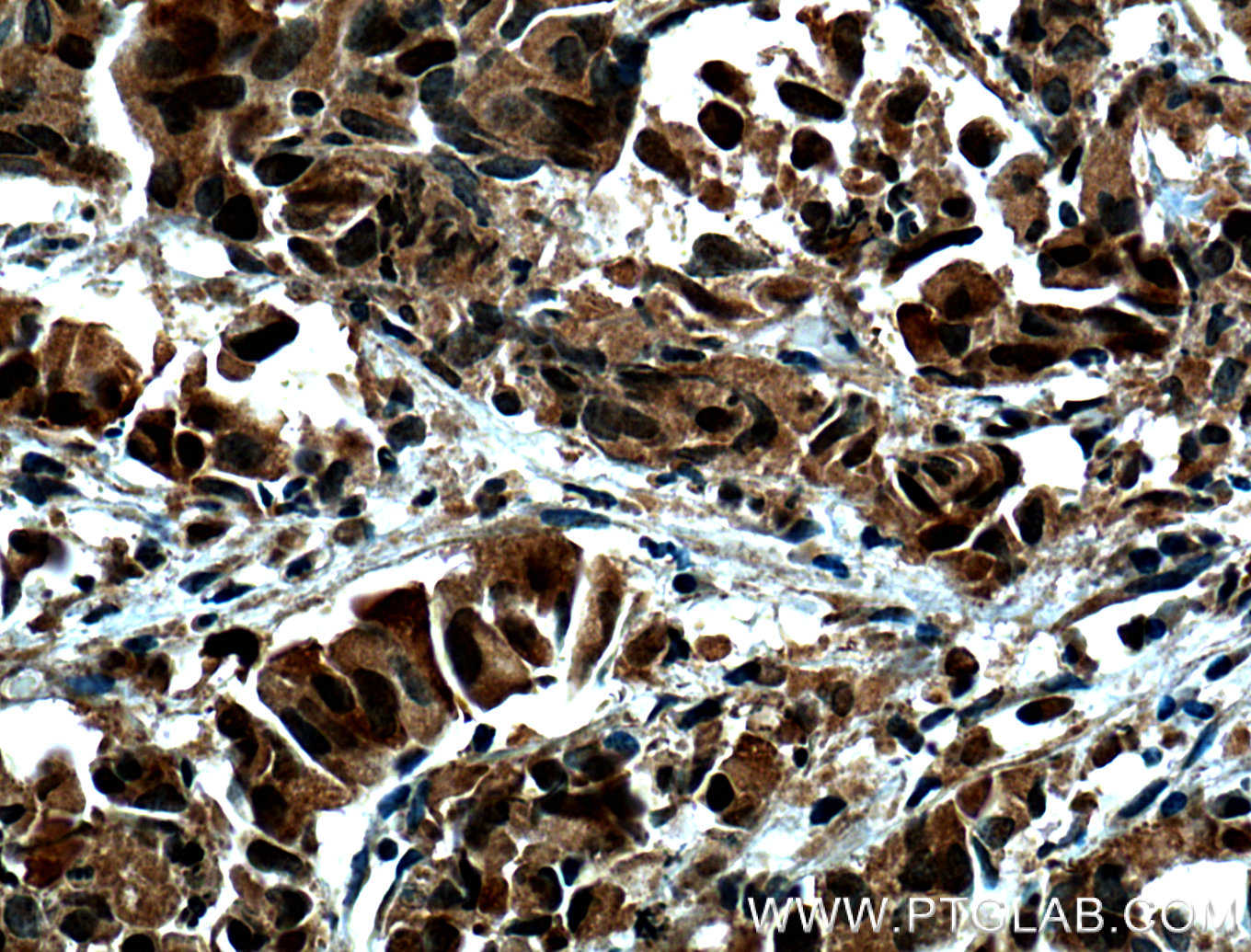 IHC staining of human prostate cancer using 12024-1-AP