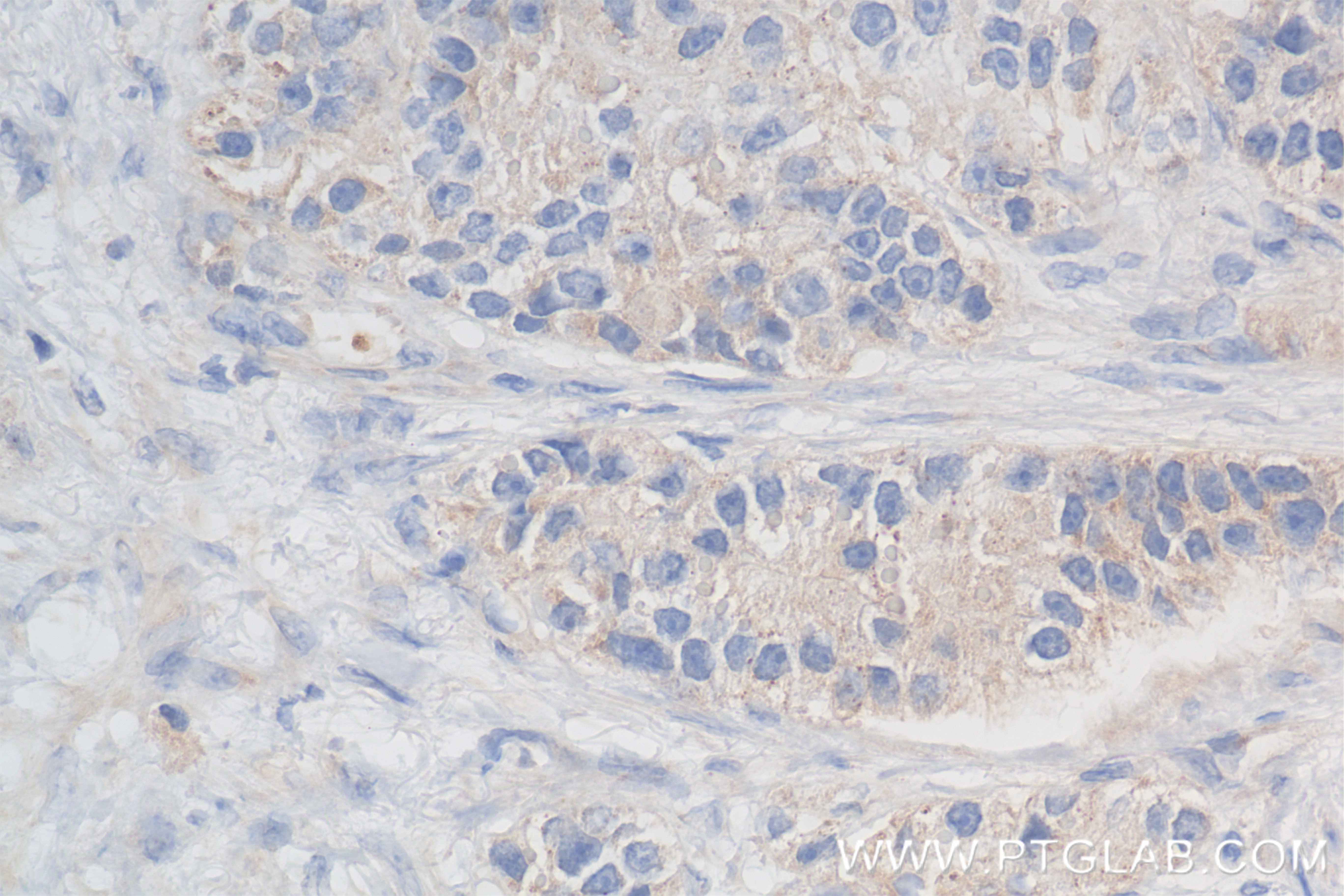 IHC staining of human stomach cancer using 85355-1-RR