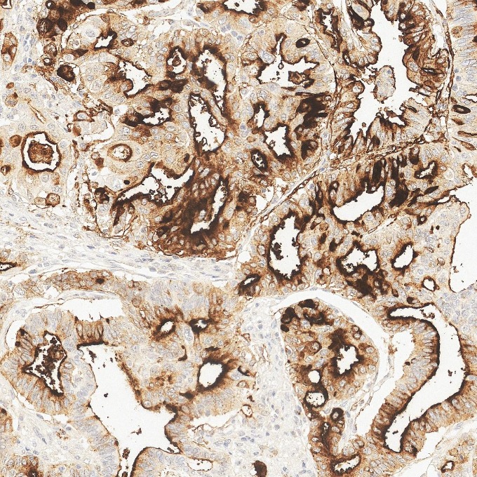 IHC staining of human pancreas cancer using 84181-1-RR IHC staining of human pancreas cancer using 84181-1-RR