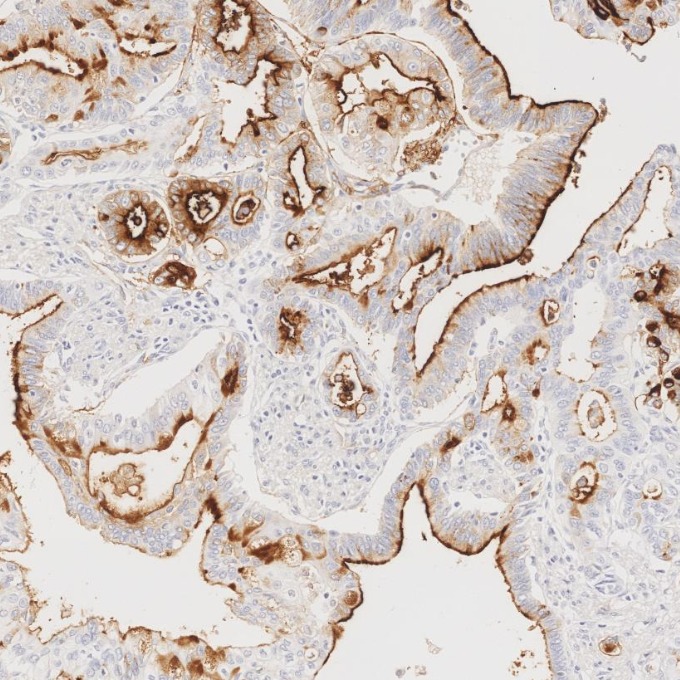 IHC staining of human pancreas cancer using 84181-1-RR IHC staining of human pancreas cancer using 84181-1-RR