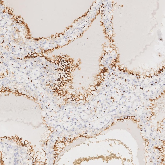 IHC staining of human renal cell carcinoma using 84181-1-RR IHC staining of human renal cell carcinoma using 84181-1-RR