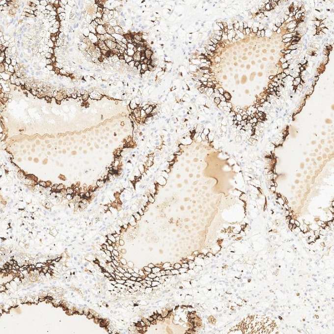 IHC staining of human renal cell carcinoma using 84181-1-RR IHC staining of human renal cell carcinoma using 84181-1-RR