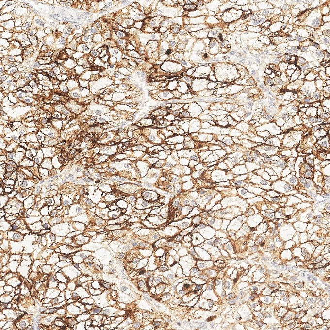 IHC staining of human renal cell carcinoma using 84181-1-RR IHC staining of human renal cell carcinoma using 84181-1-RR