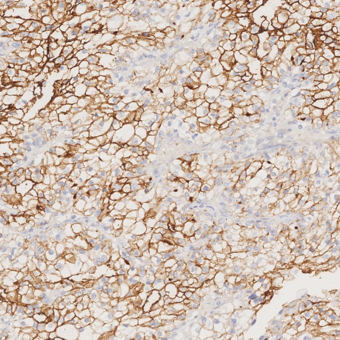 IHC staining of human renal cell carcinoma using 84181-1-RR IHC staining of human renal cell carcinoma using 84181-1-RR