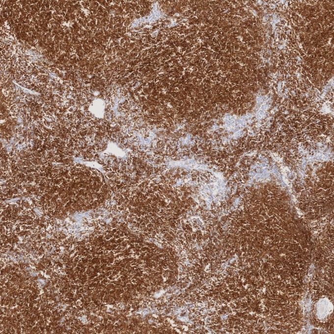 IHC staining of human lymphoma using 84181-1-RR IHC staining of human lymphoma using 84181-1-RR