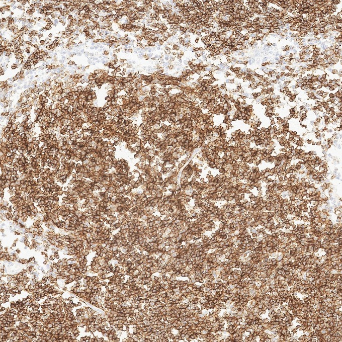 IHC staining of human lymphoma using 84181-1-RR IHC staining of human lymphoma using 84181-1-RR
