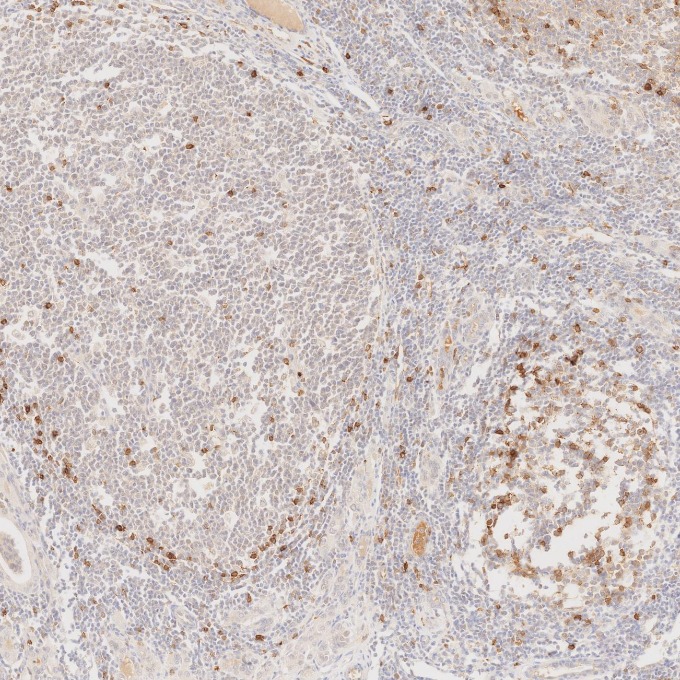 IHC staining of human lymphoma using 84181-1-RR IHC staining of human lymphoma using 84181-1-RR