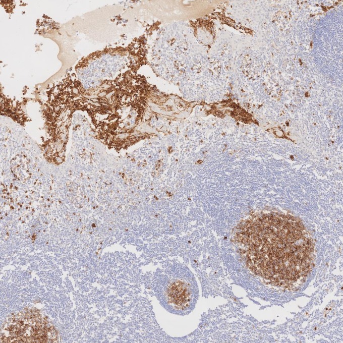 IHC staining of human tonsillitis using 84181-1-RR IHC staining of human tonsillitis using 84181-1-RR