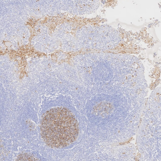 IHC staining of human tonsillitis using 84181-1-RR IHC staining of human tonsillitis using 84181-1-RR