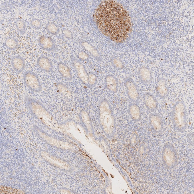 IHC staining of human appendicitis using 84181-1-RR IHC staining of human appendicitis using 84181-1-RR