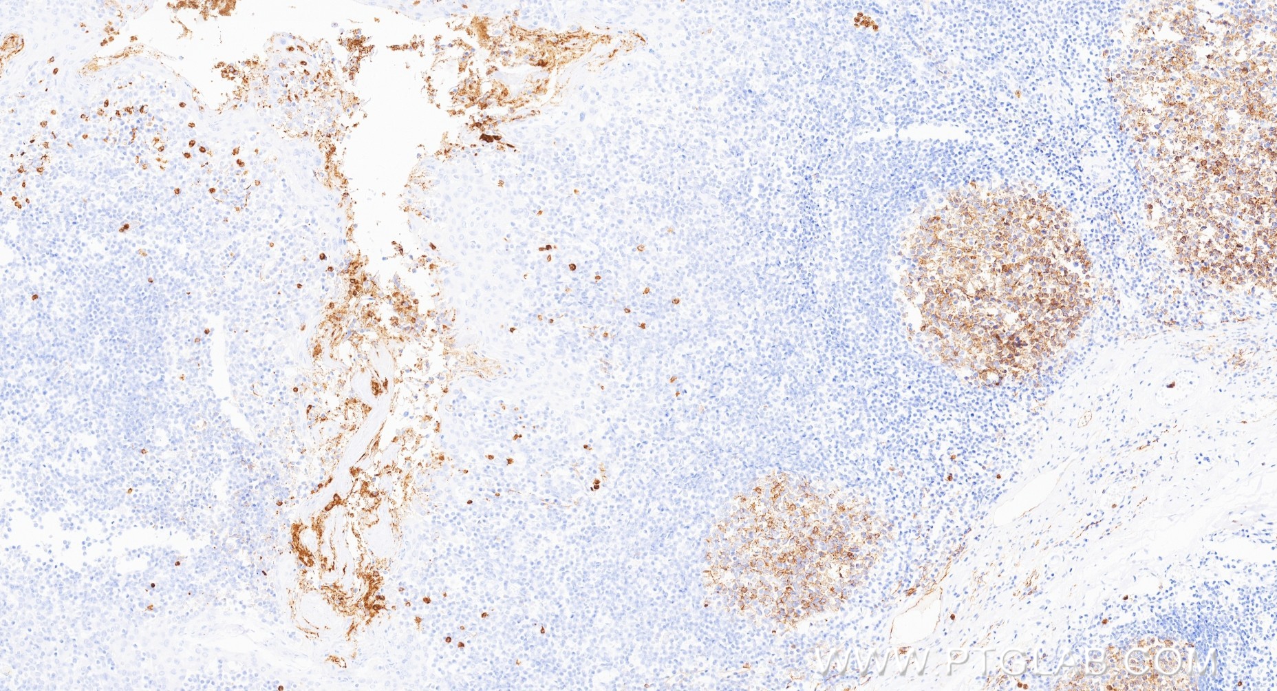 IHC staining of human tonsillitis using 84181-5-RR (same clone as 84181-5-PBS) IHC staining of human tonsillitis using 84181-5-RR (same clone as 84181-5-PBS)
