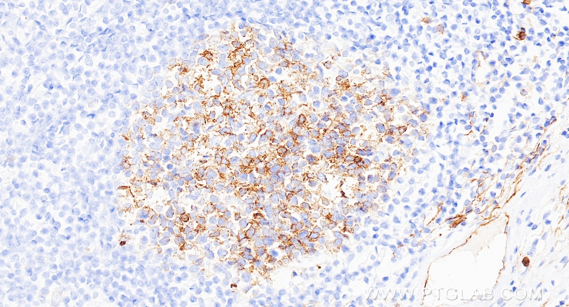 IHC staining of human tonsillitis using 84181-5-RR (same clone as 84181-5-PBS) IHC staining of human tonsillitis using 84181-5-RR (same clone as 84181-5-PBS)