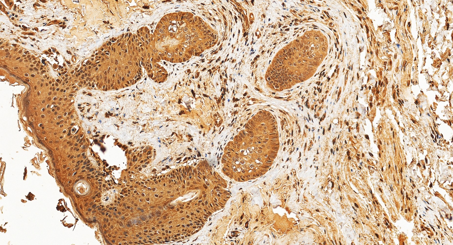 IHC staining of human skin squamous cell cancer using 31095-1-AP