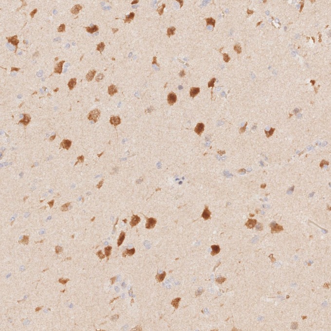 IHC staining of human gliomas using 66836-1-Ig IHC staining of human gliomas using 66836-1-Ig