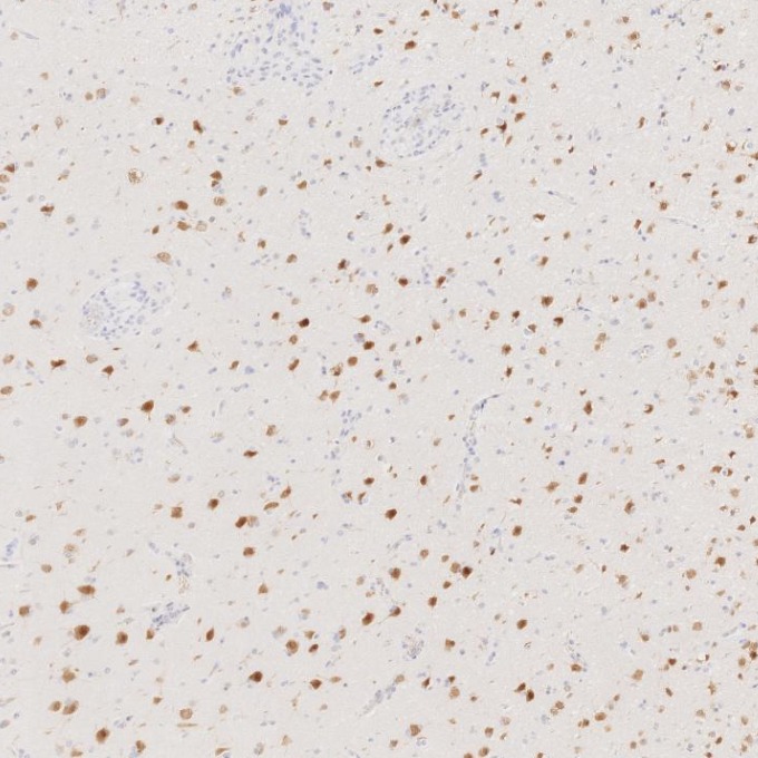 IHC staining of human gliomas using 66836-1-Ig IHC staining of human gliomas using 66836-1-Ig