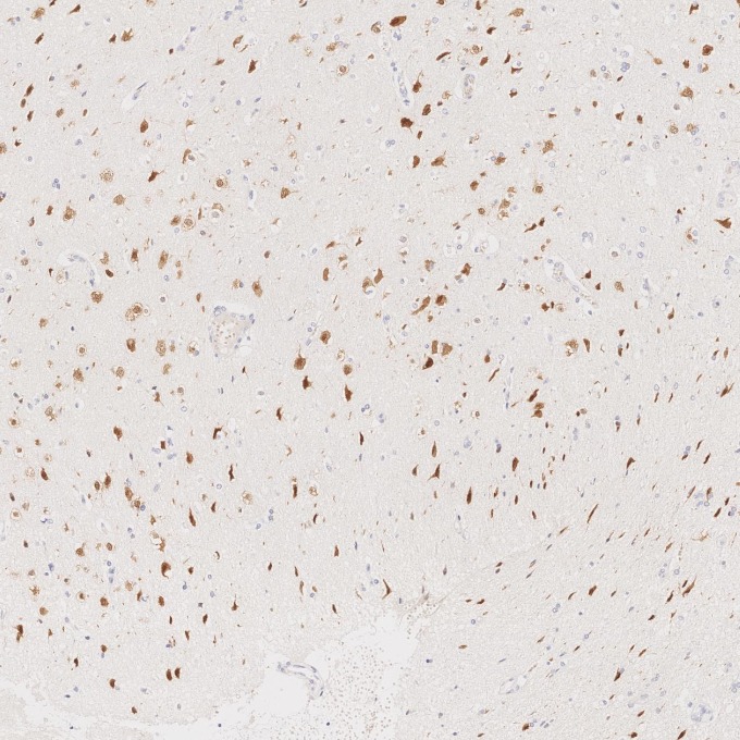 IHC staining of human gliomas using 66836-1-Ig IHC staining of human gliomas using 66836-1-Ig