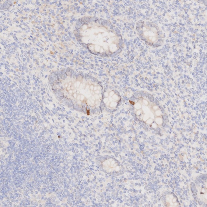 IHC staining of human appendicitis using 66836-1-Ig