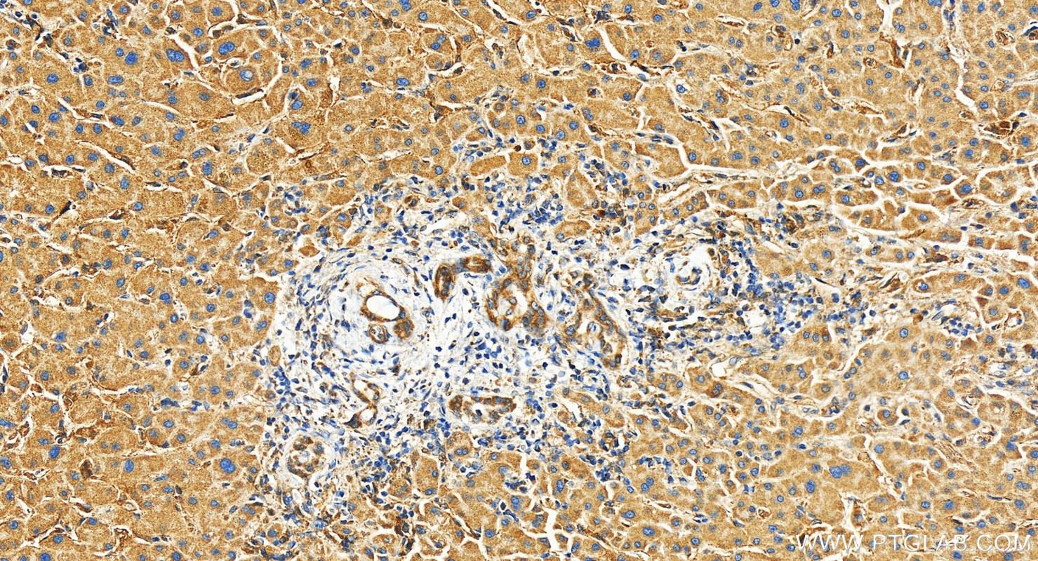 IHC staining of human intrahepatic cholangiocarcinoma using 27193-1-AP