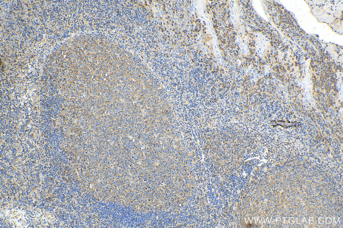 IHC staining of human tonsillitis using 69018-1-Ig