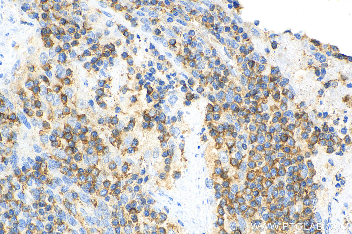 IHC staining of human tonsillitis using 69018-1-Ig